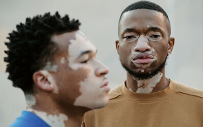 Vitiligo modely