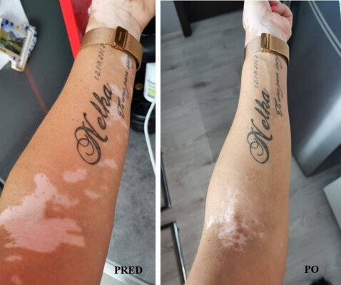 vitiligo liecba